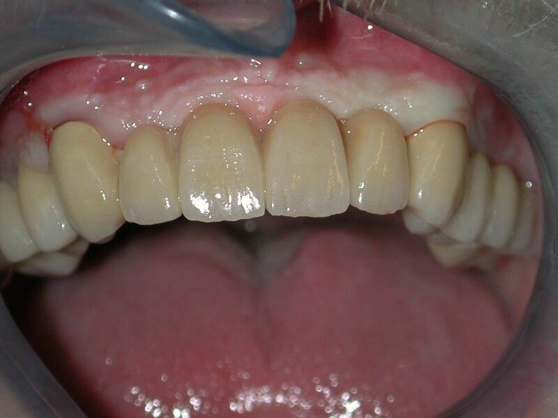 Keramikbrücke - Nachher