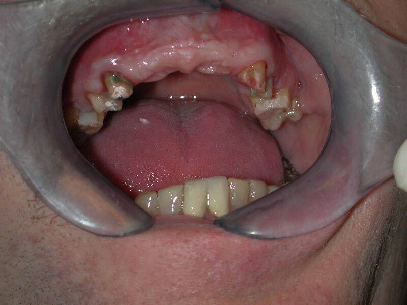 Keramikbrücke - Vorher