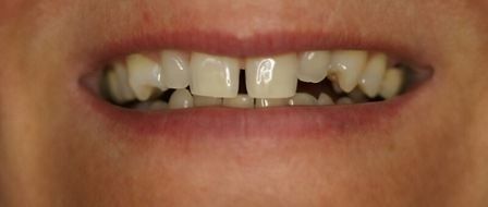 Non Prep Veneers - Vorher
