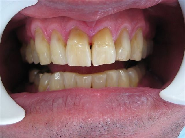 Non Prep Veneers - Vorher