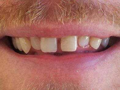Non Prep Veneers - Vorher