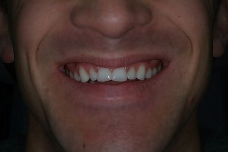 Non Prep Veneers - Vorher
