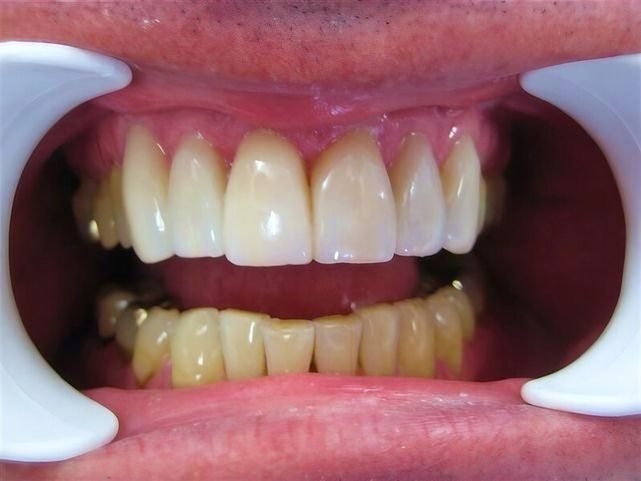 Non Prep Veneers - Nachher