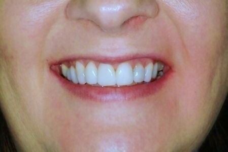 Non Prep Veneers - Nachher