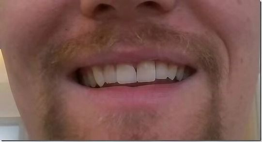 Non Prep Veneers - Nachher