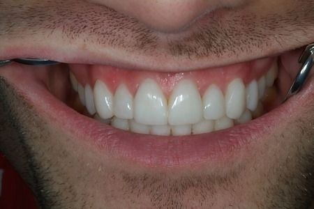 Non Prep Veneers - Nachher
