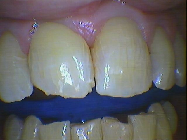 Keramische Versorgung - Vorher