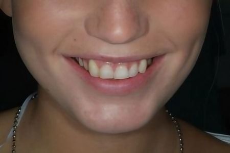 Non Prep Veneers - Vorher