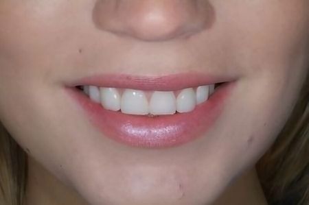 Non Prep Veneers - Nachher
