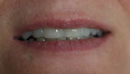 Non Prep Veneers - Nachher