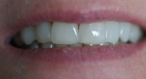 Non Prep Veneers - Nachher